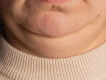 Uzmanlara göre boyun kalınlığı, obezite ve kalp hastalıklarının erken uyarı sinyali olabilir uzmanlara gore boyun kalinligi obezite ve kalp hastaliklarinin erken uyari sinyali olabilir P5jmr5WM.jpg