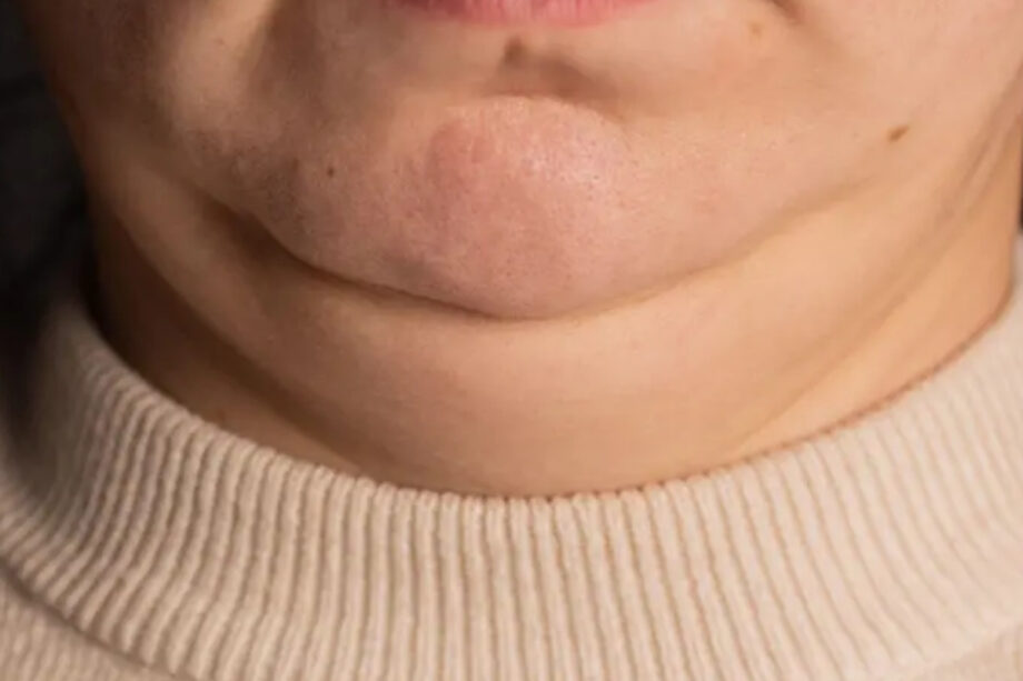 Uzmanlara göre boyun kalınlığı, obezite ve kalp hastalıklarının erken uyarı sinyali olabilir uzmanlara gore boyun kalinligi obezite ve kalp hastaliklarinin erken uyari sinyali olabilir P5jmr5WM.jpg