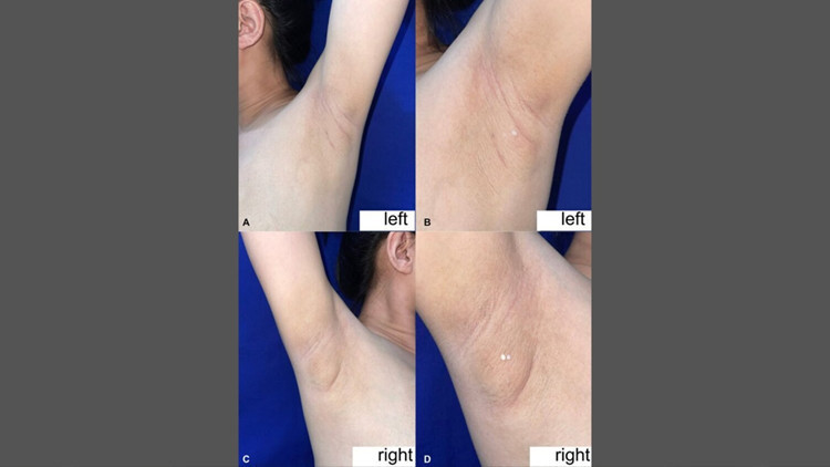 filipinli kadinin koltukaltindan sut geldi nadir gorulen durumun nedeni ne YEH117jZ.jpg